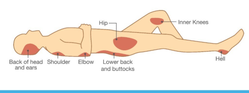 La gestione delle lesioni da pressione 
